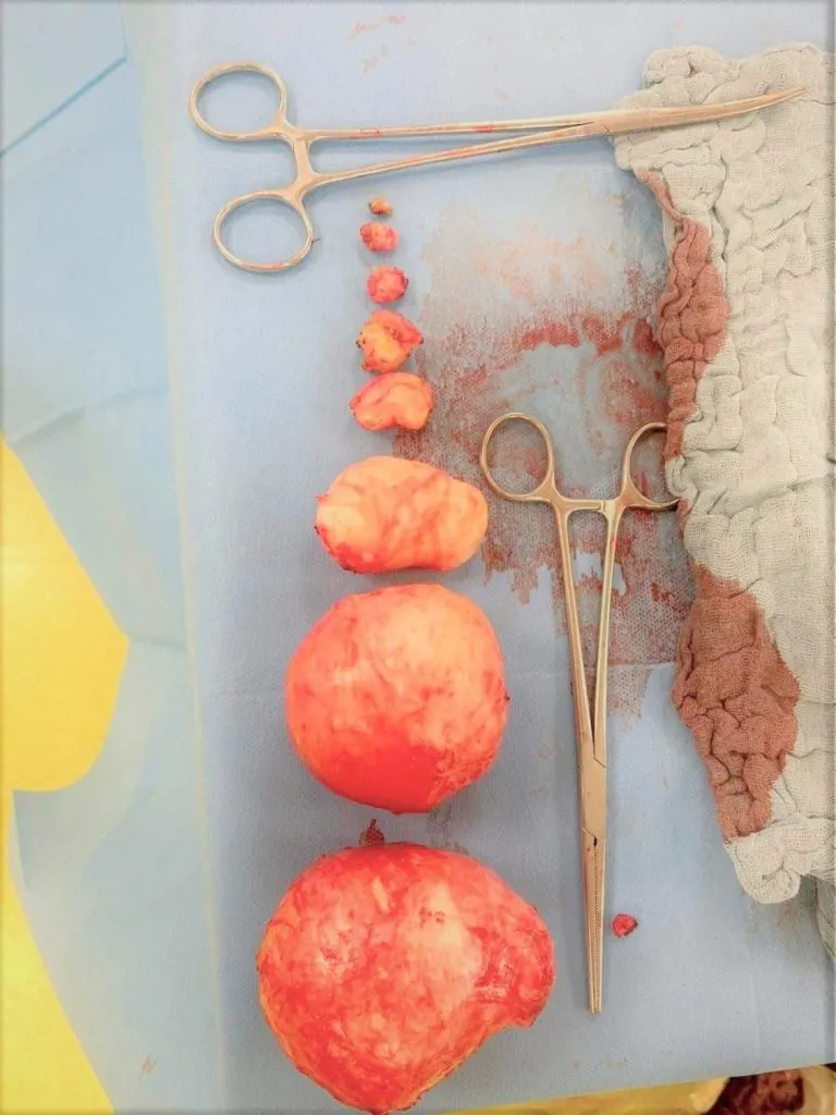 Pacientă cu opt fibroame, operată cu succes la Constanța   – foto 2