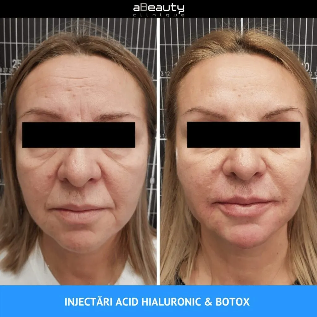 aBeauty Clinique ridică botoxul la rang de artă – foto 3