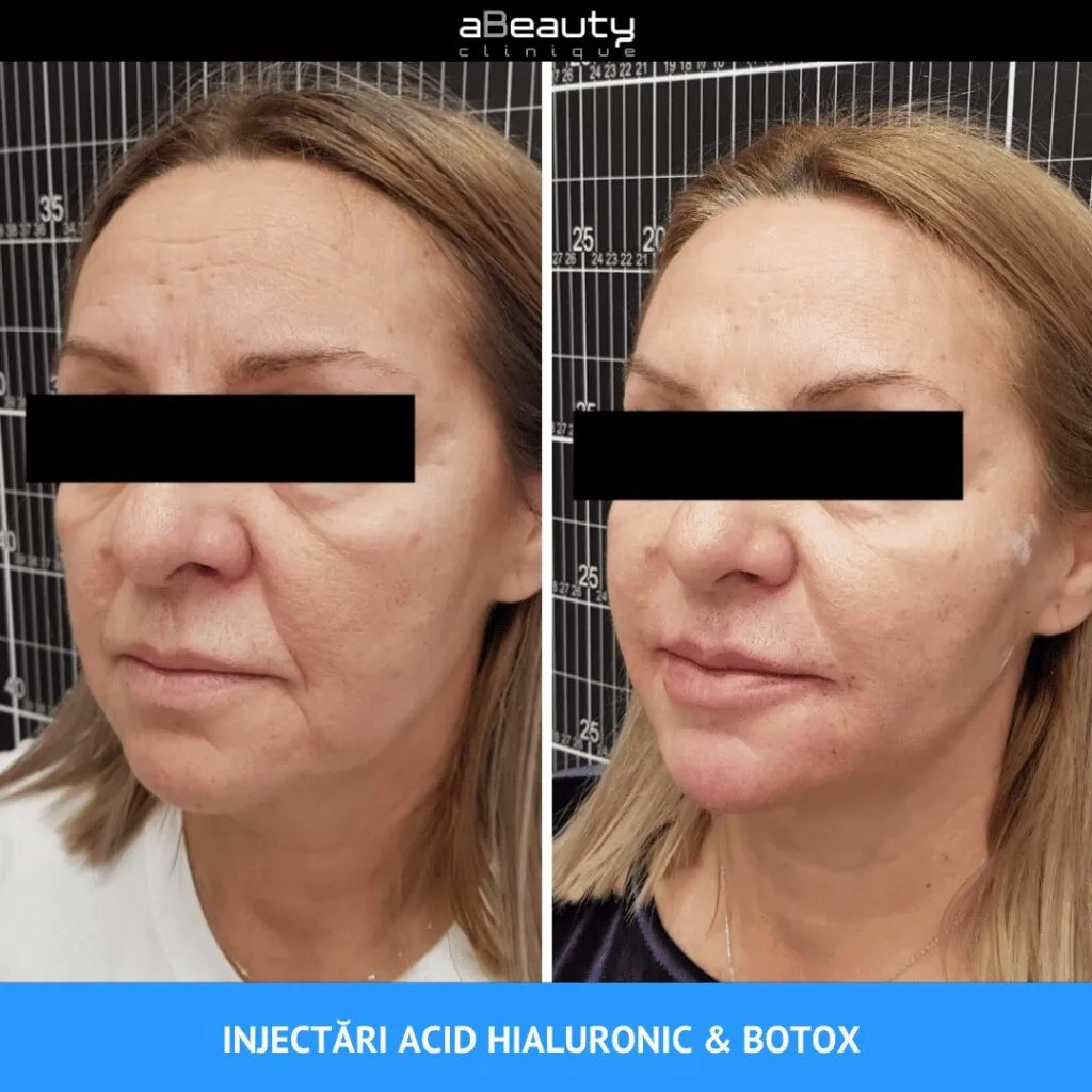 aBeauty Clinique ridică botoxul la rang de artă – foto 4