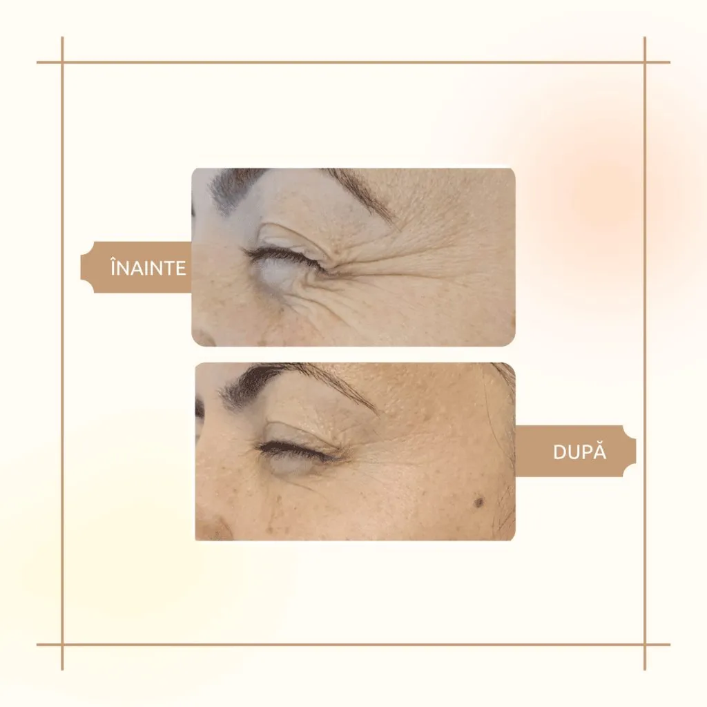 aBeauty Clinique ridică botoxul la rang de artă – foto 6