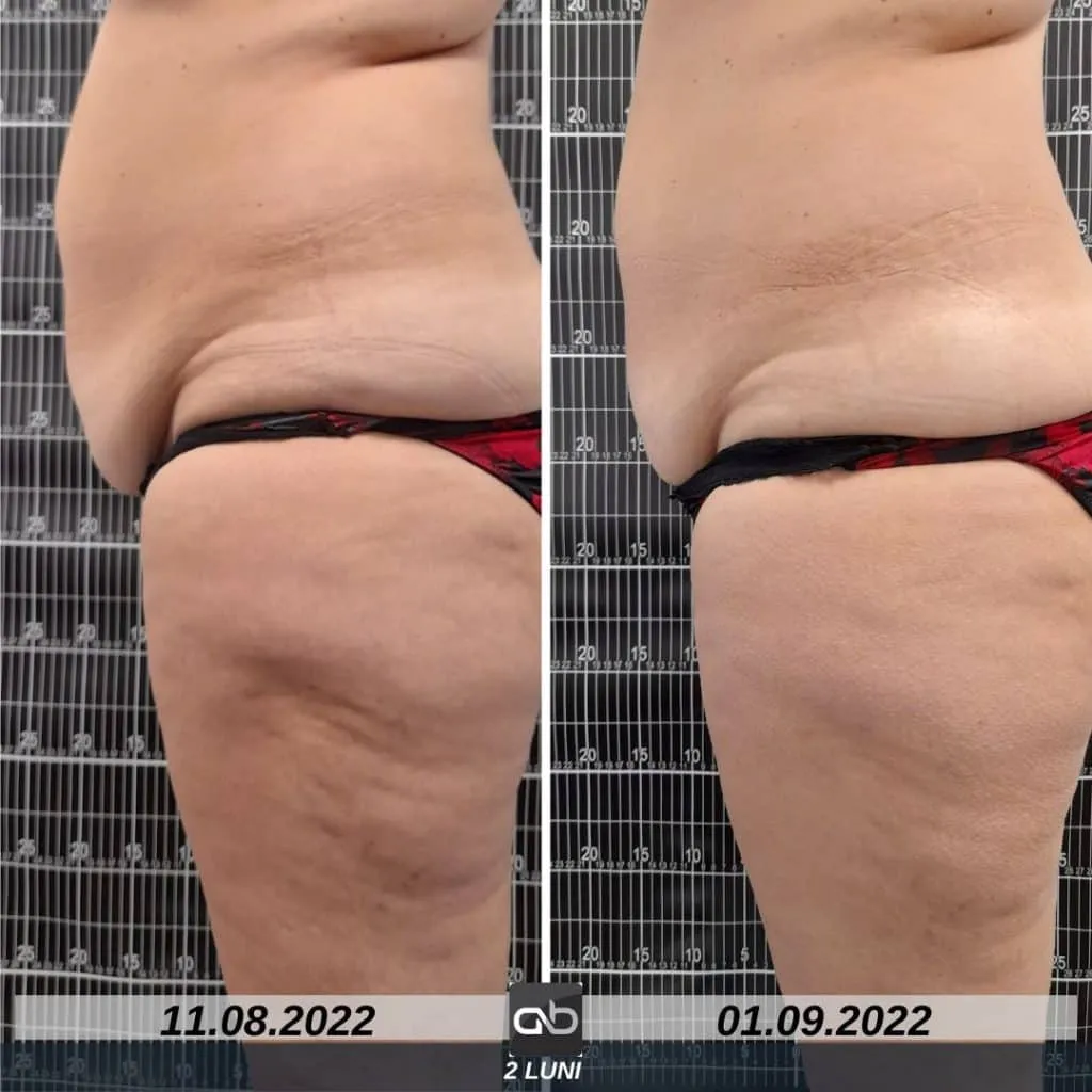 aBeauty Clinique vă recomandă BodyShape, regele slăbirii neinvazive – foto 5