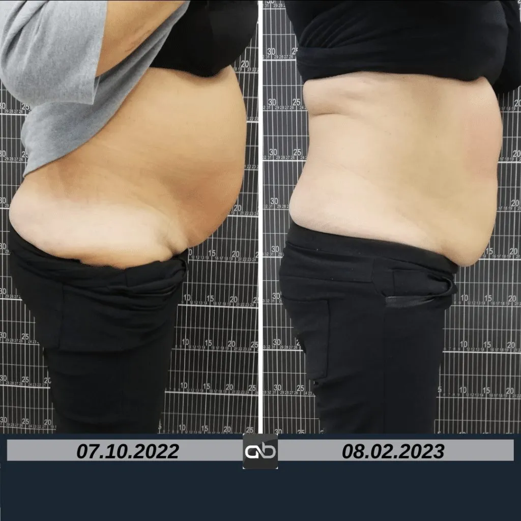aBeauty Clinique vă recomandă BodyShape, regele slăbirii neinvazive – foto 6