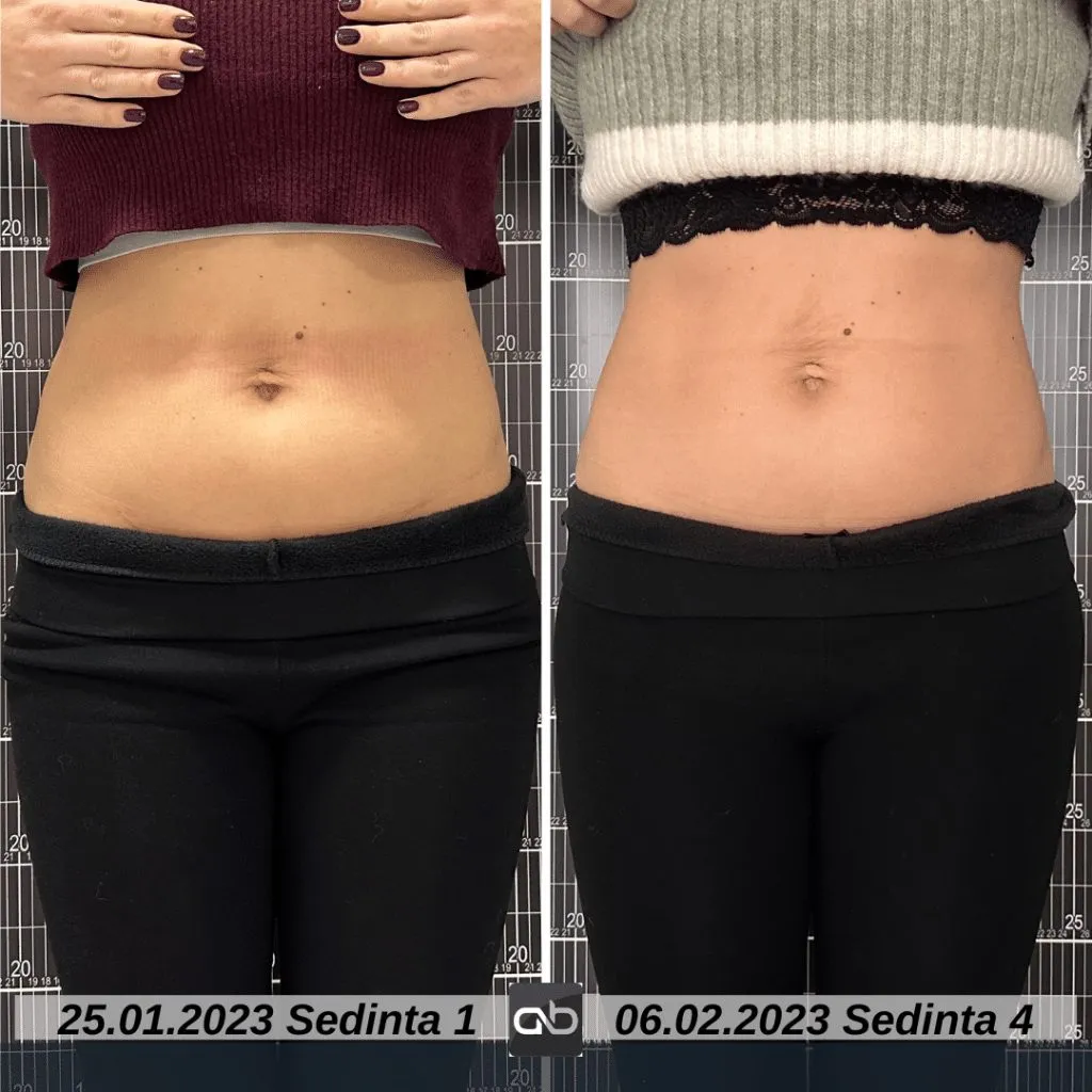 aBeauty Clinique vă recomandă BodyShape, regele slăbirii neinvazive – foto 8