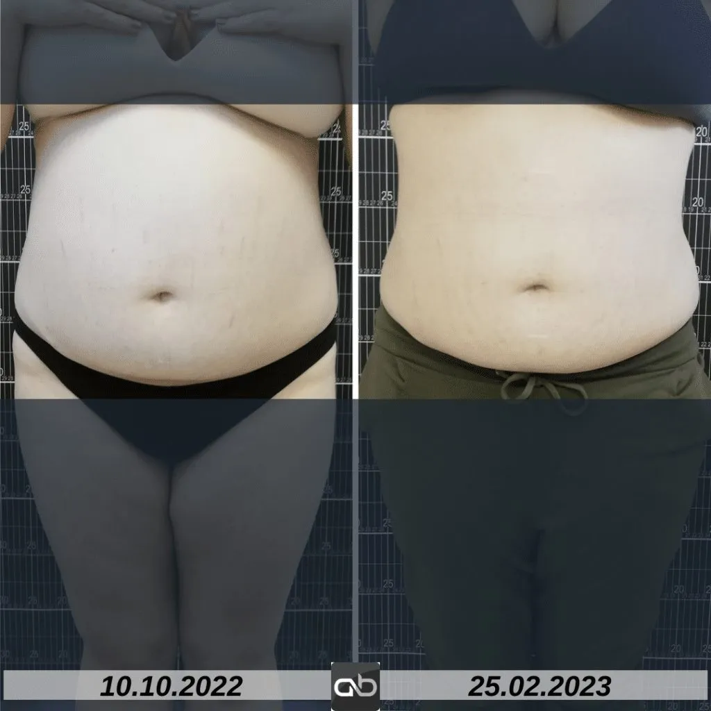 aBeauty Clinique vă recomandă BodyShape, regele slăbirii neinvazive – foto 10