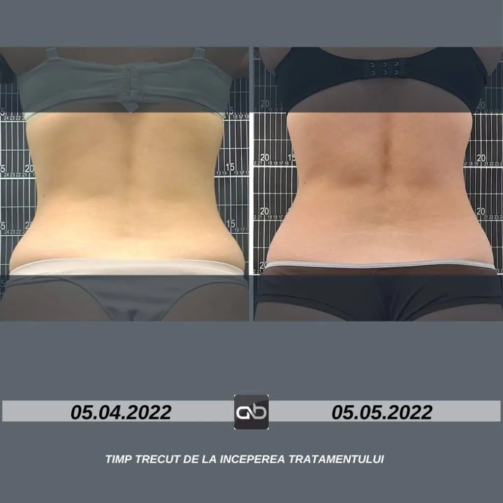 aBeauty Clinique vă recomandă BodyShape, regele slăbirii neinvazive – foto 11
