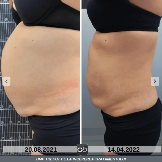 Abeauty Clinique Constanța vă propune Criolipoliza la -11°C pentru rezultate vizibile, fără efort – foto 3