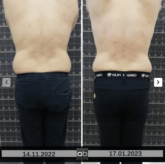Abeauty Clinique Constanța vă propune Criolipoliza la -11°C pentru rezultate vizibile, fără efort – foto 13