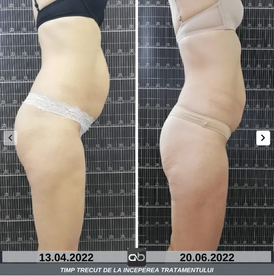 Abeauty Clinique Constanța vă propune Criolipoliza la -11°C pentru rezultate vizibile, fără efort – foto 6